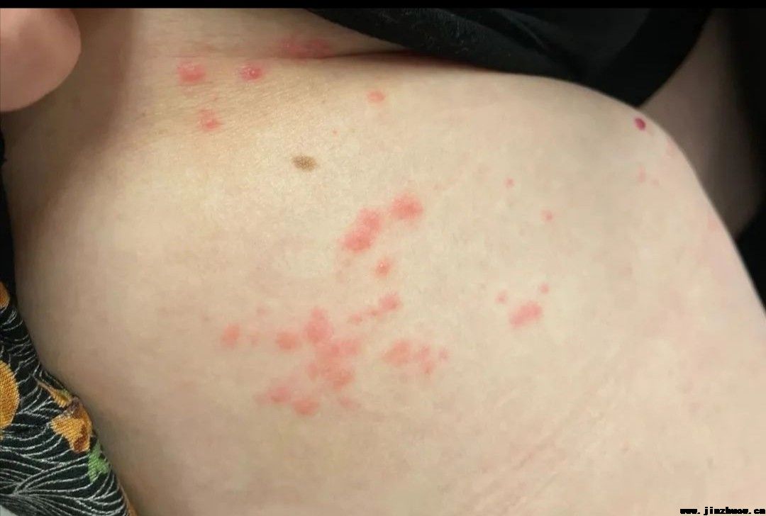 可以治疗带状疱疹得中药材